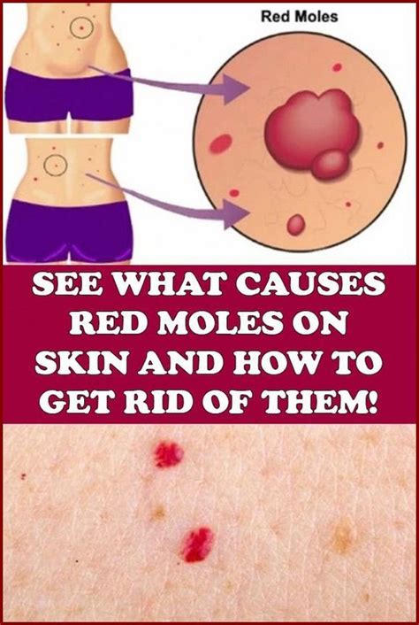 What Causes Red Moles on Skin in 2024 | Skin moles, Red moles, Skin growths