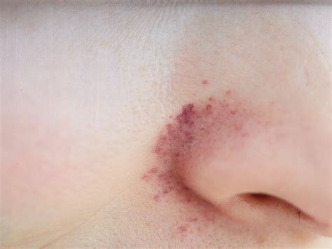 how to fix redness around nose