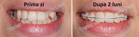 Aparatul dentar de safir - Orto Implant Expert - o alternativa mai ...