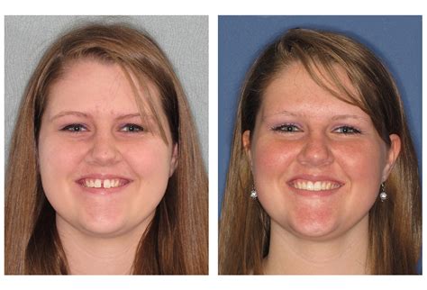 See Amazing Invisalign Before & After Transformations - BriteSmile Dental