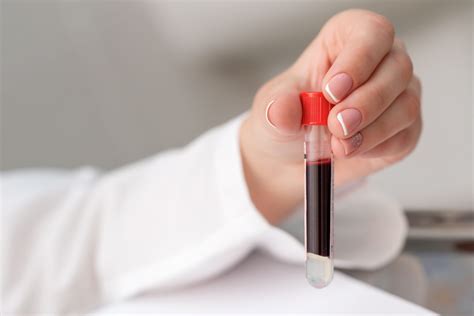 O Que É Ferro Serico No Exame De Sangue - Ferro sérico: tudo o que você precisa saber sobre o exame