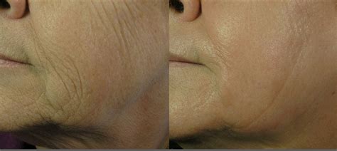 www.sasmedspa.com Laser Wrinkle Treatment