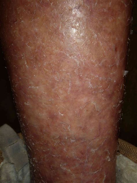 Gluten Intolerance Symptoms Rash