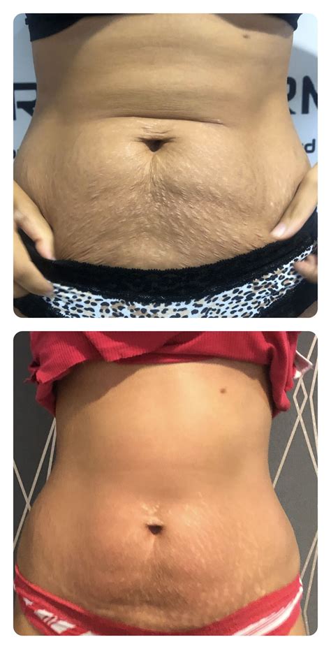 Tummy Tuck Without Surgery: Minimally Invasive Alternatives | Aesthetic