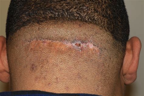 Scalp Keloids - Acne Keloidalis - Treatment with cryotherapy