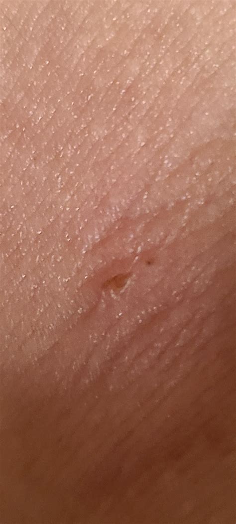 5 Critical Signs You Might Be Bitten By A Brown Recluse