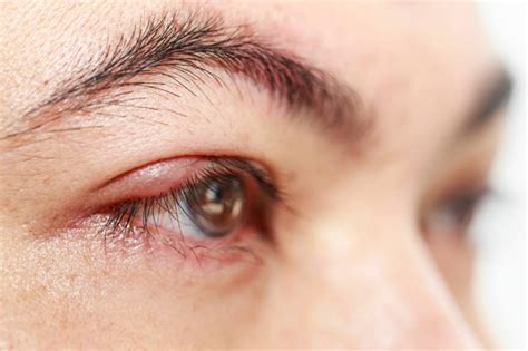 Troubled with Blepharitis? Try These 8 Home Remedies | New Health Advisor