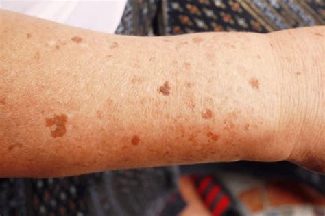 O Que Pode Ser Manchas Marrom Na Pele - Manchas na pele? Médica explica quando sinais exigem consulta urgente ...