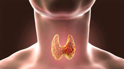 Tiroid Belirtileri Nelerdir? Tiroid Hastalarına Doğal Çözüm » Fit ve Form