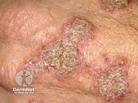 Discoid eczema. Discoid eczema