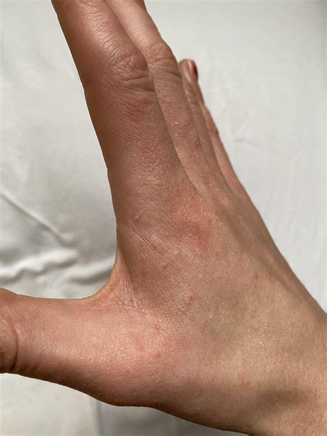 Scabies or post-scabies? : r/scabies