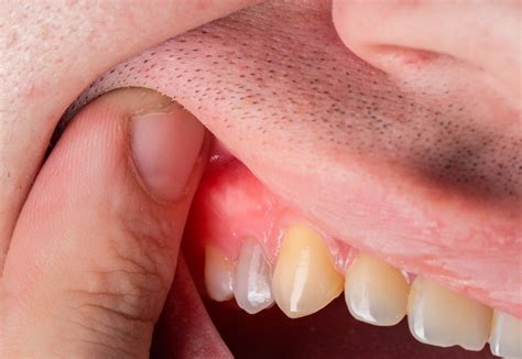 energency dental abscess treatment amitis dental studio