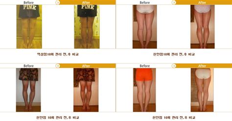 Bow Leg Treatment, Bow Legs Correction