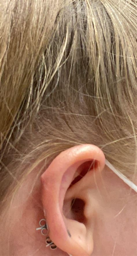 Hypertrophic scar on 8 year old cartilage piercing? : r/PiercingAdvice