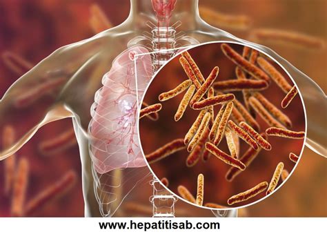 What is Bone Tuberculosis Treatment