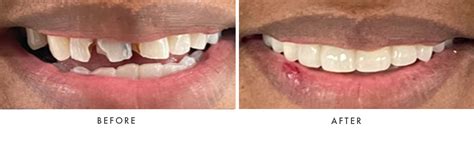 Before & After Photos | Winter Haven Dental | Winter Haven, FL