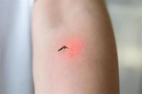 Mosquito Bite Remedy Stock Photos, Images and Backgrounds for Free Download