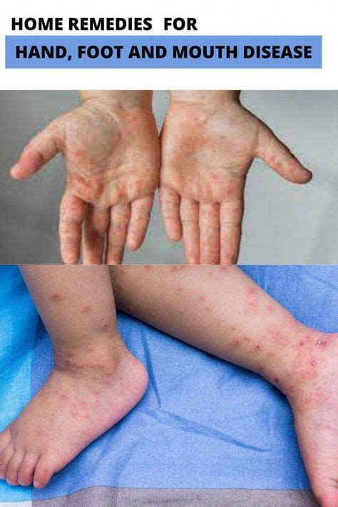 #WhatAreOralCare #OralHealthAndHygiene