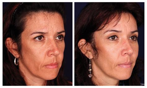 Lifting Endoscópico Antes E Depois - Lifting Endoscópico ¡Refresca tu Rostro sin cicatrices!