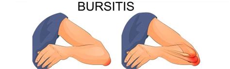 bursitis  symptoms  treatments