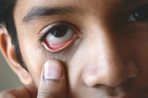 Olho De Pessoa Com Anemia - Impacto del color de ojos cuando tienes anemia y su salud
