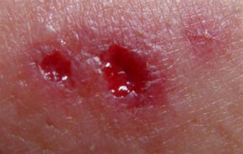 Wolf Spider Bite Stages