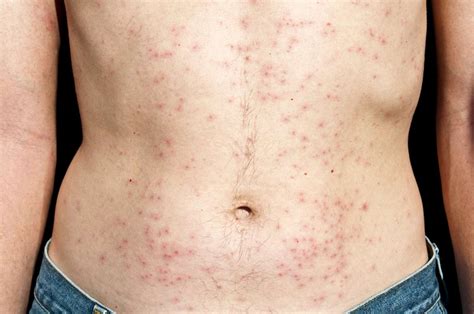 types  hiv rashes    treat