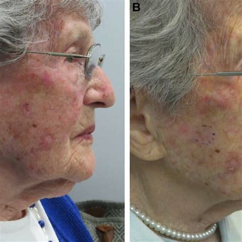Basal cell carcinoma of the face. a, Before treatment. B, after ...