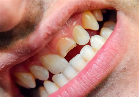 broken teeth common  treatment  prevention