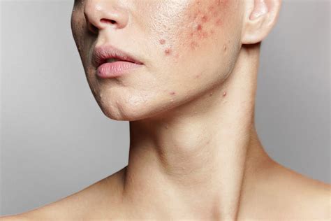 types  acne    treat  pleij salon spa