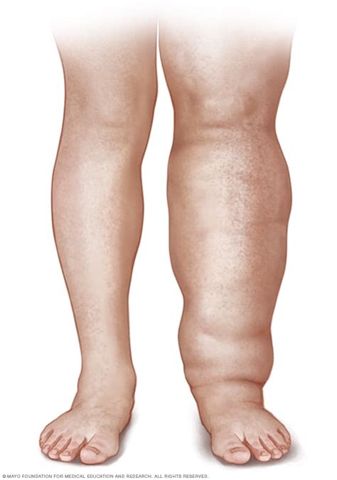 Linfedema Síntomas Y Causas Mayo Clinic, 41% OFF