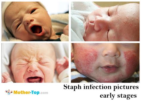 Staph Infection In Babies Pictures - PictureMeta