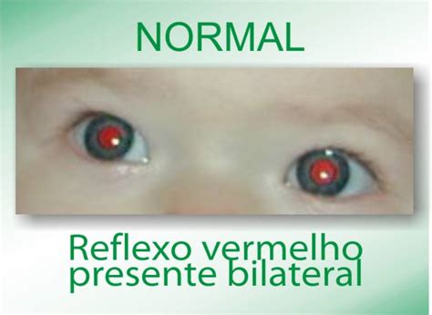 O Teste Positivo Será Observado Com Pesticida - O QUE É O TESTE DO REFLEXO VERMELHO ? | CMS Prof. Masao Goto