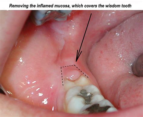 Pericoronitis Infection