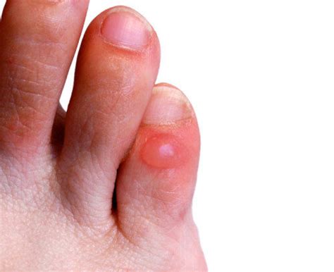 avoid blisters   feet river podiatry    foot