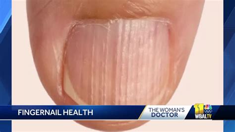 What fingernails can signal about your health