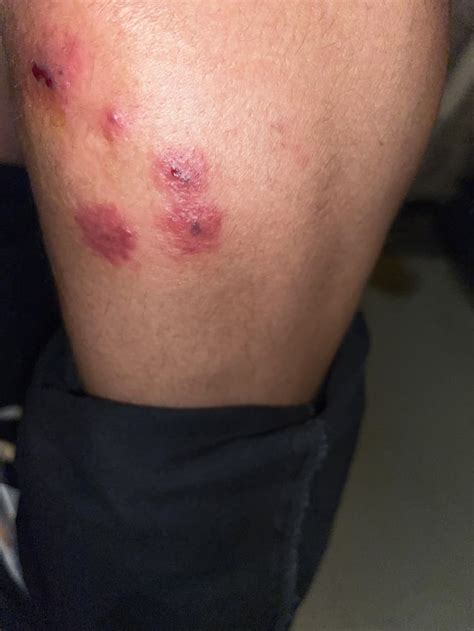 I got bitten by something 8-9 days ago, it wasn’t as red but still very ...