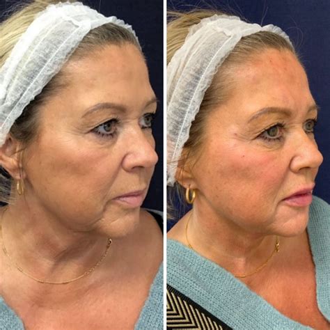Non Surgical Facelift Treatment for Models - Cosmetic Courses