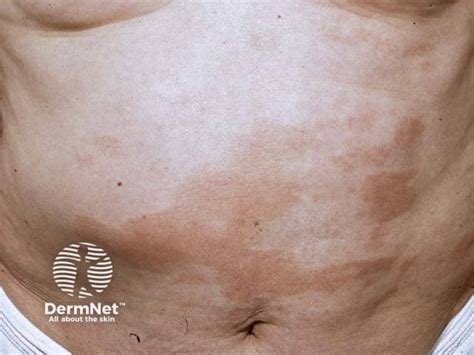 Chronic superficial scaly dermatitis image