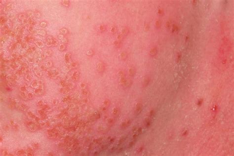 types  eczema pure medical