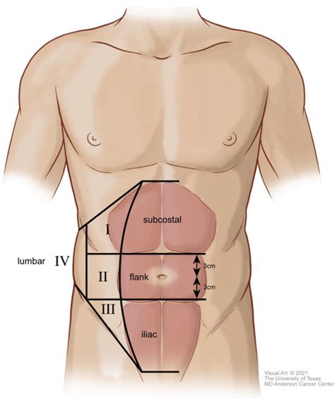 European Hernia Society lateral abdominal wall hernia anatomic ...