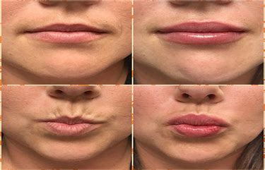 Lip Flip Before And After » Lip Flip Botox