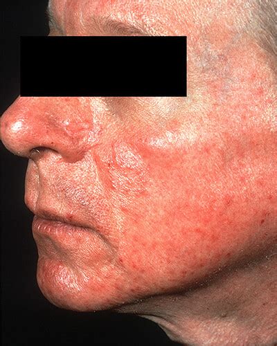 The Many Faces of Rosacea | Rosacea.org