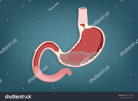 pain  upper left abdomen images stock  vectors shutterstock