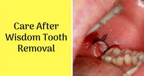 how to care for wisdom teeth removal