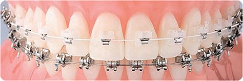 Брекеты: из чего изготавливаются и какой материал лучше? ⋆ orthogid.ru