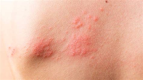 Le zona : causes, symptômes, traitements