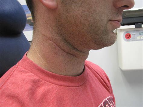 2nd Arch Branchial Cleft Cyst Case Example | Iowa Head and Neck