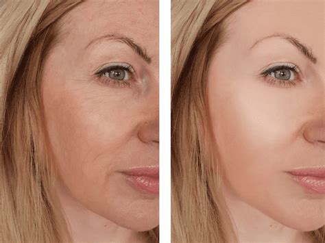 Fillers For Under Eye Wrinkles Before and After Results