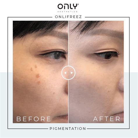 singapore ultimate guide  pigmentation removal